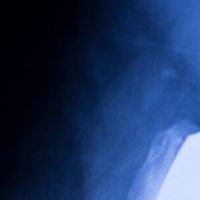 x-ray of hip implant