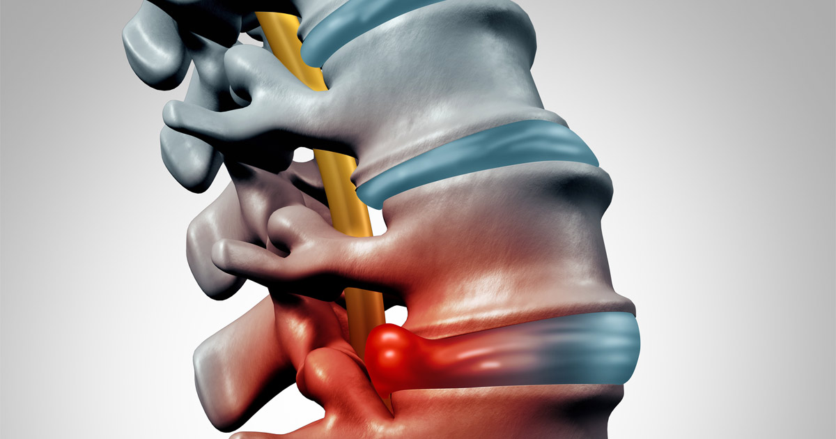 Herniated Disc | Philadelphia Workers' Compensation Lawyers