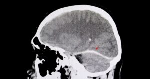 brain injury x-ray