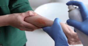 Burn awareness